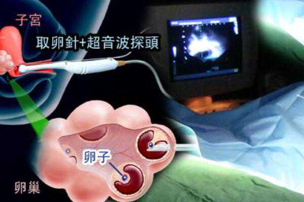 广州供卵试管要求,广州南方医院供卵_哪家代孕公司专业