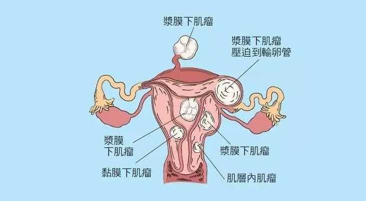 广州代孕价格官网|崇左45岁做试管婴儿检查发现子宫长了瘤子，能不做手术吗？